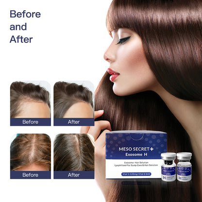 Exosome Hair Solution Lyophilized For Scalp Care & Hair Solution